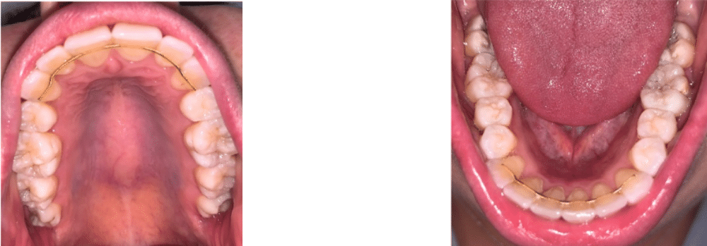 Photo of an intraoral orthodontic selfie