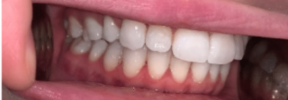 Photo of an intraoral orthodontic selfie