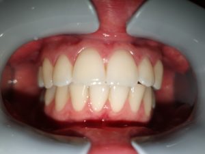 Photo taken too close in dental monitoring