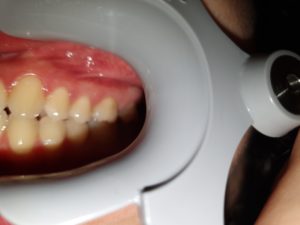 Photo taken too close in dental monitoring