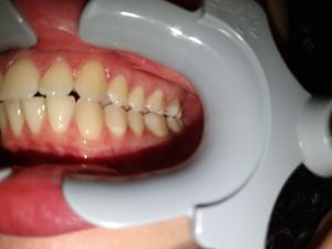 Photo taken too close in dental monitoring