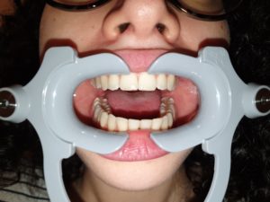 photo for dental monitoring for occlusal