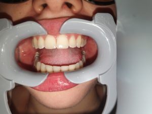 Photos for Dental Monitoring lips hiding teeth