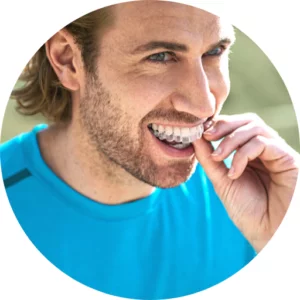 everything you need to know about clear aligners