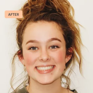 Grace's braces transformation