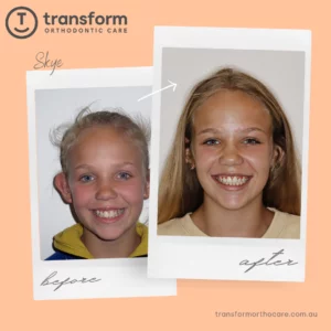 Smile makeover by Adelaide's top orthodontist