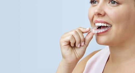 Invisalign clear aligners