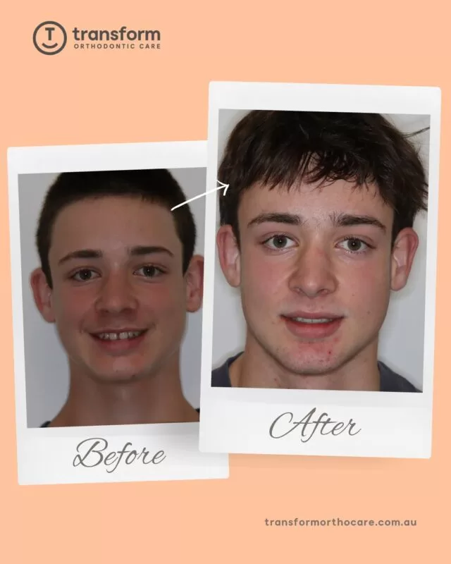 Well done, Harry, on completing orthodontic treatment ðThis treatment involved full upper and lower orthodontic care to improve bite alignment and reduce spacing ✨ Functional bite adjustment was addressed before refining alignment, guided by individual clinical assessment.Disclaimer: Images are published with patient consent. The images shown reflect the outcome achieved for this individual; results vary from person to person. A full clinical examination is required to determine whether treatment is appropriate.#TransformOrthodonticCare #BracesOff #OrthodonticTreatment #AdelaideOrthodontist