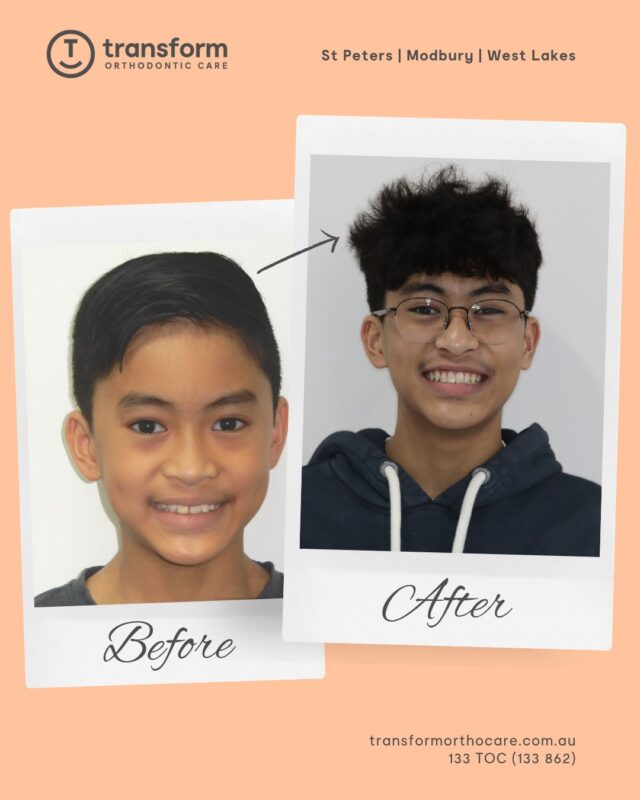 Orthodontic treatment began with a bite-correcting appliance to help address how the upper and lower teeth relate to each other. This was followed by braces to further align the teeth and refine the bite.This approach was used to manage concerns such as overbite, increased overjet, crowding, and spacing. By guiding tooth movement over time, the goal is to support improved alignment and a more balanced bite.Disclaimer: Images are published with patient consent. The images shown reflect the outcome achieved for this individual. A full clinical examination is required to determine whether treatment is appropriate.133 TOC (862)
transformorthocare.com.au#TransformOrthodonticCare #BracesOff #OrthodonticTreatment #AdelaideOrthodontist #BracesTreatment