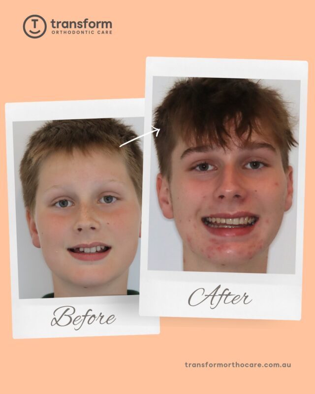 Congratulations, Reuben, on your smile journey! ðThis treatment involved a bite corrector appliance to address a deep bite, followed by upper and lower braces. The plan focused on functional bite correction before refining alignment, with each stage progressed according to ongoing clinical assessment.Disclaimer: Images are published with patient consent. The images shown reflect the outcome achieved for this individual; results vary from person to person. A full clinical examination is required to determine whether treatment is appropriate.#TransformOrthodonticCare #BracesOff #OrthodonticTreatment #AdelaideOrthodontist #BracesTreatment