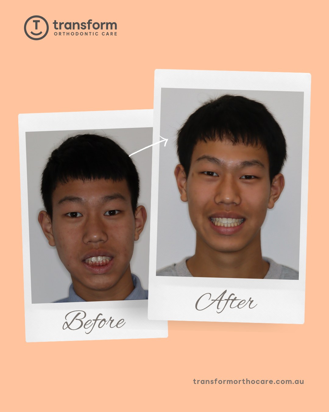 Jason’s smile journey combined a bite adjustment appliance and braces to achieve a functional bite and beautifully aligned teeth ✨This approach allowed us to correct the bite first before refining the alignment and reducing space, resulting in an outstanding outcome.Thank you, Jason, for your dedication and commitment to the process! ð---
Disclaimer: Images are published with patient consent. They have been converted to greyscale and minimally blurred for privacy. No alterations have been made that could mislead or exaggerate treatment outcomes. These images represent the results for one individual only; results vary from person to person. A full clinical examination is required to determine whether a treatment is appropriate for you.#TransformOrthodonticCare #BeforeAndAfter #Orthodontist #Braces #JawAligner #OrthodonticSpecialist #AdelaideOrthodontist