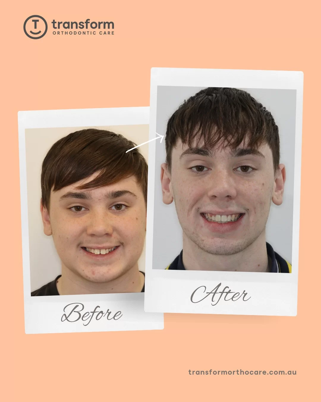 Amazing results achieved through a combination of a jaw aligner appliance and braces! ✨We’d like to thank Caleb for his dedication in following the treatment plan and trusting the process, it truly shows in the results ðThe jaw aligner appliance helped correct the overbite, setting the foundation for braces in aligning the teeth. This creates a smile that looks great and feels even better.---
Disclaimer: Images are published with patient consent. They have been converted to greyscale and minimally blurred for privacy. No alterations have been made that could mislead or exaggerate treatment outcomes. These images represent the results for one individual only; results vary from person to person. A full clinical examination is required to determine whether a treatment is appropriate for you.#TransformOrthodonticCare #Orthodontist #AdelaideOrthodontist #orthodontistSA #Braces #JawAlignment #BeforeAndAfter