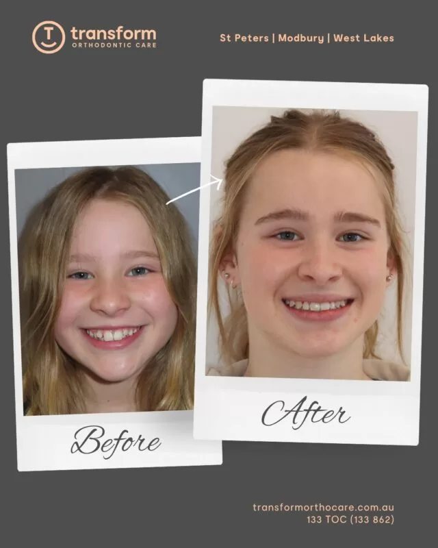 In this case, fixed braces were used on the upper and lower teeth to address crowding and increased overjet (when the top front teeth sit further forward than the lower teeth).Treatment focused on gradually aligning the teeth and improving how the upper and lower jaws come together, supporting a more balanced bite.Disclaimer: Images are published with patient consent. The images shown reflect the outcome achieved for this individual. A full clinical examination is required to determine whether treatment is appropriate.133 TOC (862)
transformorthocare.com.au#TransformOrthodonticCare #BracesOff #OrthodonticTreatment #AdelaideOrthodontist #BracesTreatment
