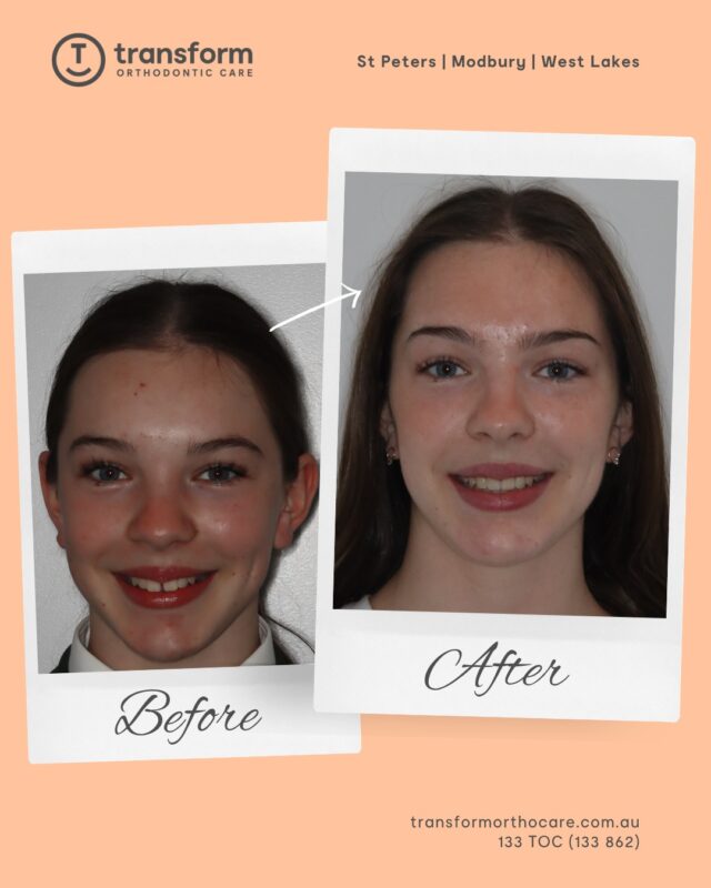 Treatment began with a bite corrector appliance to help address the relationship between the upper and lower teeth, followed by upper and lower braces to  support tooth movement and assist with alignment.This approach was used to manage concerns such as spacing, overbite, and increased overjet. By guiding tooth movement over time, the aim was to support improved alignment and a more balanced bite.Disclaimer: Images are published with patient consent. The images shown reflect the outcome achieved for this individual. A full clinical examination is required to determine whether treatment is appropriate.133 TOC (862)
transformorthocare.com.au#TransformOrthodonticCare #OrthodonticTreatment #AdelaideOrthodontist #BracesOff #BiteCorrectorAppliance