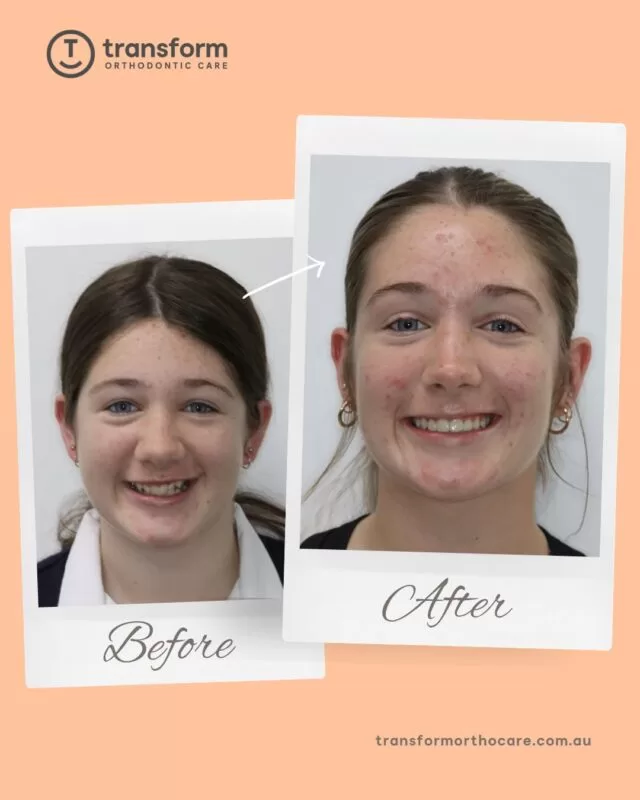 Treatment began with a bite corrector appliance to help address crowding, irregular tooth alignment, and a deep overbite. This was followed by upper and lower braces to gradually guide the teeth into improved positions.Treatment aimed to address upper incisor protrusion, spacing, increased overjet and the deep overbite, support improved dental alignment and bite.Disclaimer: Images are published with patient consent. The images shown reflect the outcome achieved for this individual. A full clinical examination is required to determine whether treatment is appropriate.133 TOC (862)
transformorthocare.com.au#TransformOrthodonticCare #BracesOff
#OrthodonticTreatment #AdelaideOrthodontist #bracestreatment