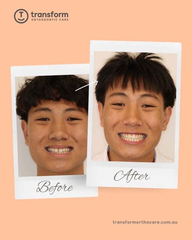 Celebrating a treatment milestone ð
We wish Bao all the best moving forward#TransformOrthodonticCare #Orthodontist #BeforeAndAfterDisclaimer: Images are published with patient consent. They have been converted to greyscale and minimally blurred for privacy. No alterations have been made that could mislead or exaggerate treatment outcomes. These images represent the results for one individual only; results vary from person to person. A full clinical examination is required to determine whether a treatment is appropriate for you.
