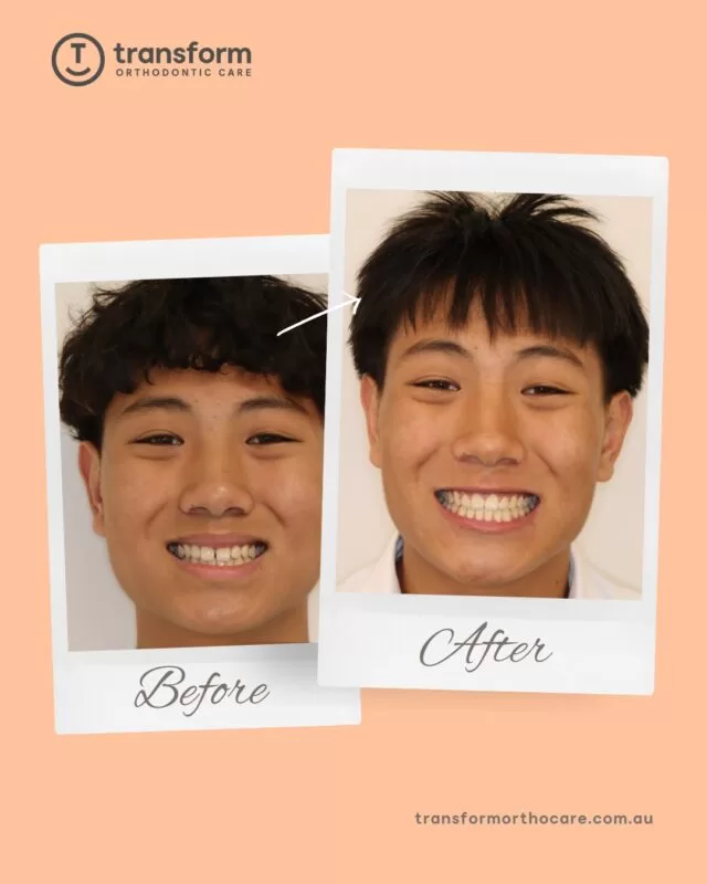 Celebrating a treatment milestone ð
We wish Bao all the best moving forward#TransformOrthodonticCare #Orthodontist #BeforeAndAfterDisclaimer: Images are published with patient consent. They have been converted to greyscale and minimally blurred for privacy. No alterations have been made that could mislead or exaggerate treatment outcomes. These images represent the results for one individual only; results vary from person to person. A full clinical examination is required to determine whether a treatment is appropriate for you.