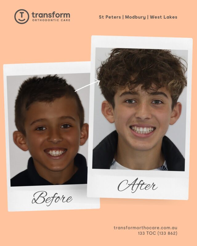 Orthodontic treatment using braces was provided to address dental crowding and alignment. Treatment duration and outcomes vary depending on individual clinical circumstances.ð 133 TOC (862)
ð transformorthocare.com.au
ðSt Peters | Modbury | West LakesDisclaimer: Images are published with patient consent. The images shown reflect the outcome achieved for this individual. A full clinical examination is required to determine whether treatment is appropriate.#TransformOrthodonticCare #BracesOff #OrthodonticTreatment #AdelaideOrthodontist #BracesTreatment