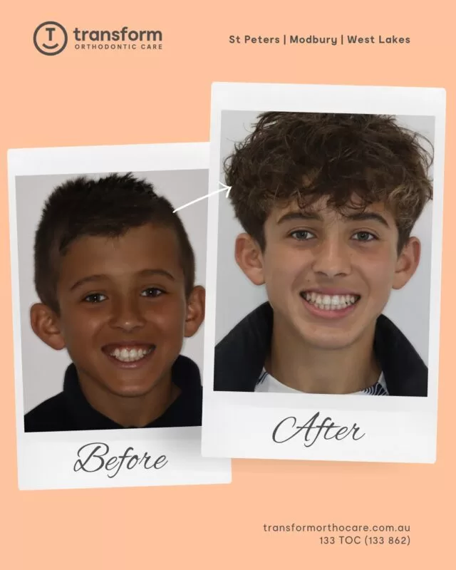 Orthodontic treatment using braces was provided to address dental crowding and alignment. Treatment duration and outcomes vary depending on individual clinical circumstances.ð 133 TOC (862)
ð transformorthocare.com.au
ðSt Peters | Modbury | West LakesDisclaimer: Images are published with patient consent. The images shown reflect the outcome achieved for this individual. A full clinical examination is required to determine whether treatment is appropriate.#TransformOrthodonticCare #BracesOff #OrthodonticTreatment #AdelaideOrthodontist #BracesTreatment