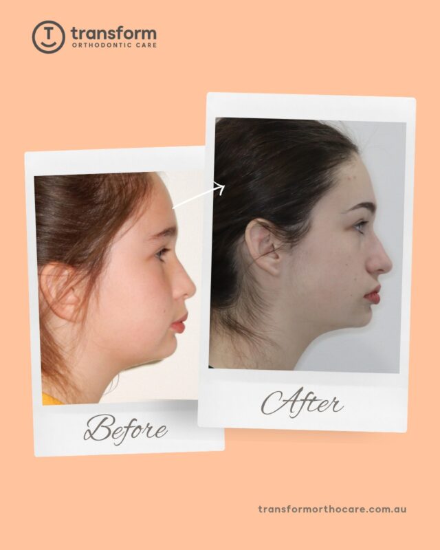 Orthodontic treatment may involve appliances such as braces, jaw correction devices, and elastics, depending on individual needs. Treatment planning is always personalised following specialist assessment.Disclaimer: Images are published with patient consent. They have been converted to greyscale and minimally blurred for privacy. No alterations have been made that could mislead or exaggerate treatment outcomes. These images represent the results for one individual only; results vary from person to person. A full clinical examination is required to determine whether a treatment is appropriate for you.#TransformOrthodonticCare #Orthodonticspecialist #BeforeAndAfter #OrthodonticTreatment #AdelaideOrthodontist #OrthodontistSA